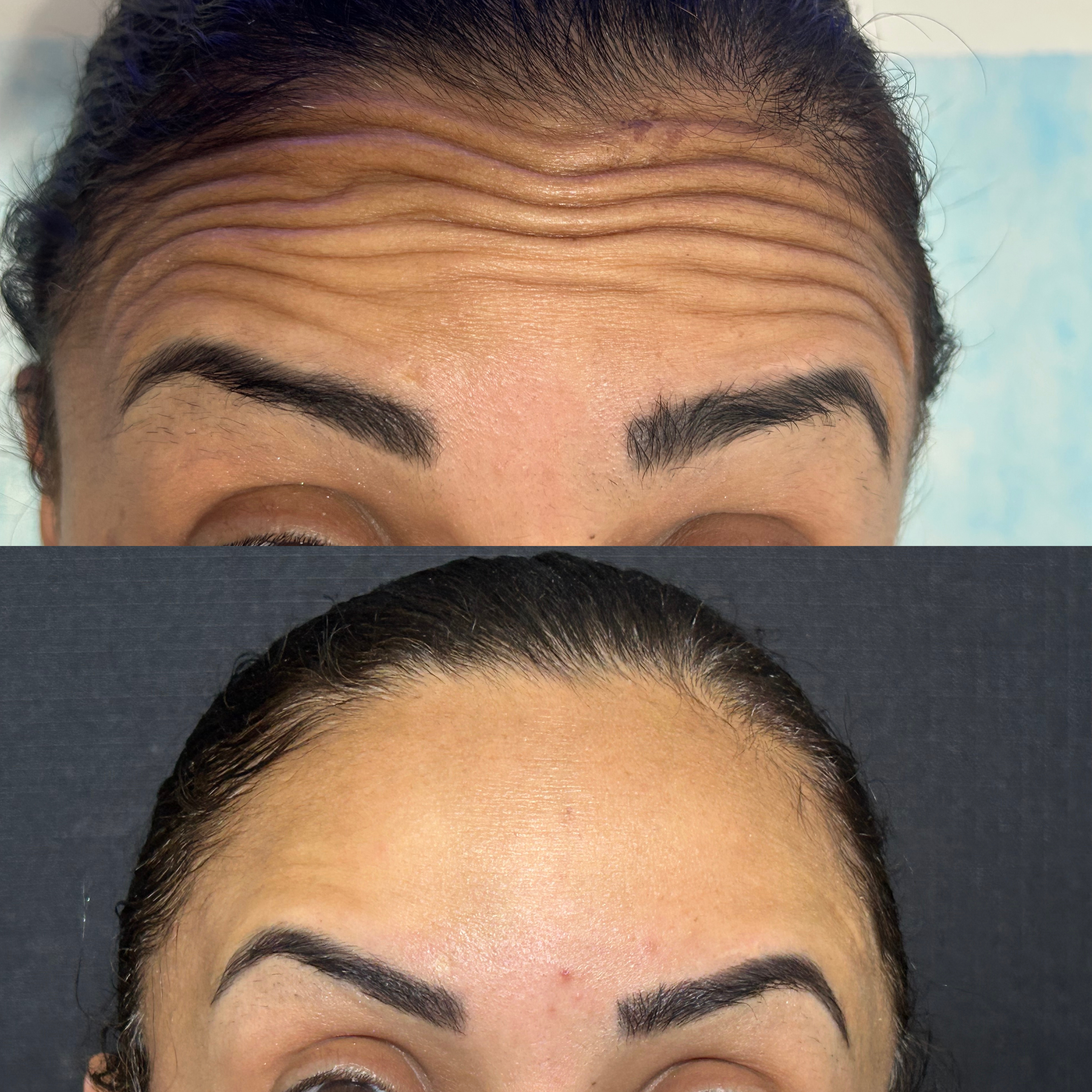 Botox